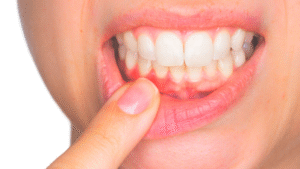 paciente observando encías retraídas y raíz dental parcialmente expuesta